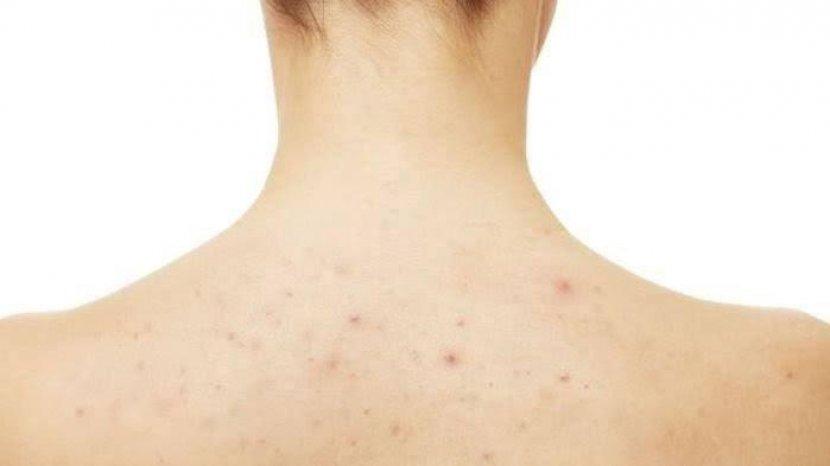 Tak Sampai 100 Ribu, Ini Pilihan Obat Jerawat Punggung yang Manjur