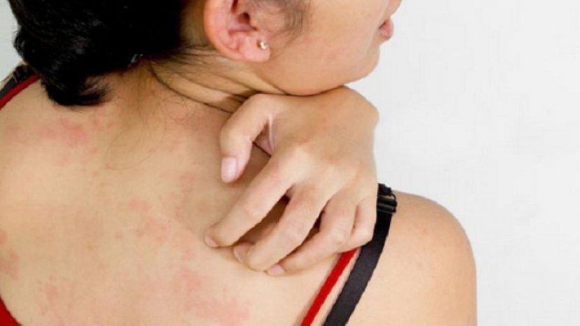 7 Bahan Alami Mengatasi Jerawat Punggung yang Gatal dan Meradang