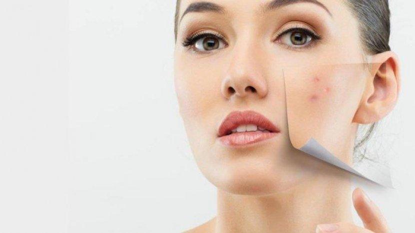 Memiliki Masalah Jerawat? Coba Atasi dengan 5 Rekomendasi Masker Ini
