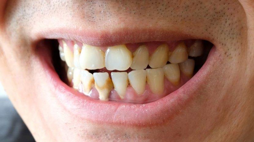 6 Cara Alami Ini Dipercaya Mengatasi Karang Gigi, Salah Satunya Kunyah Buah dan Sayur dengan Rutin