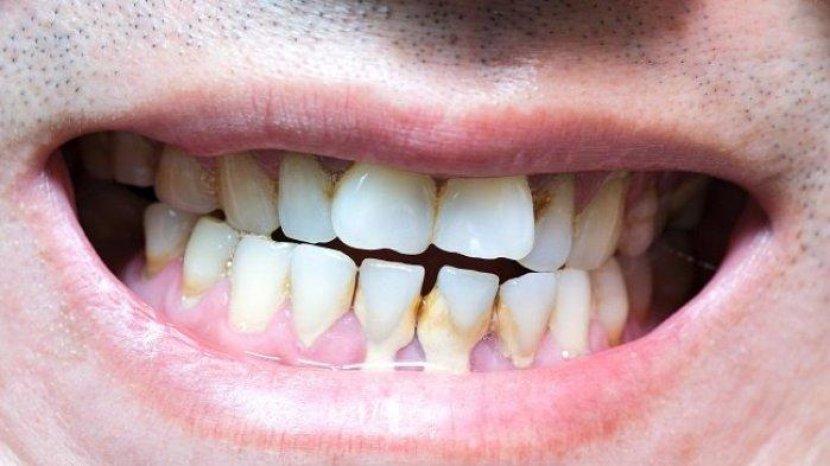 11 Bahan Alami Merontokkan Karang Gigi dengan Mudah dan Murah serta Bisa Dilakukan Sendiri di Rumah