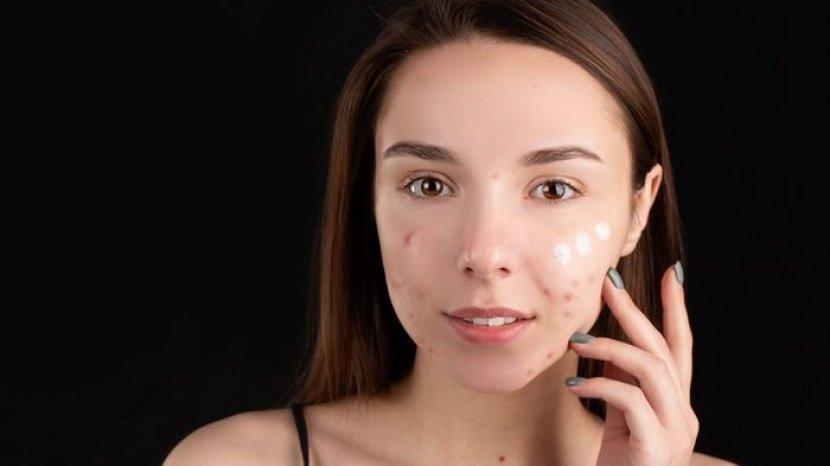 Cocok untuk Kulit Berjerawat, 5 Rangkaian dari Emina Ms. Pimple Acne Solution