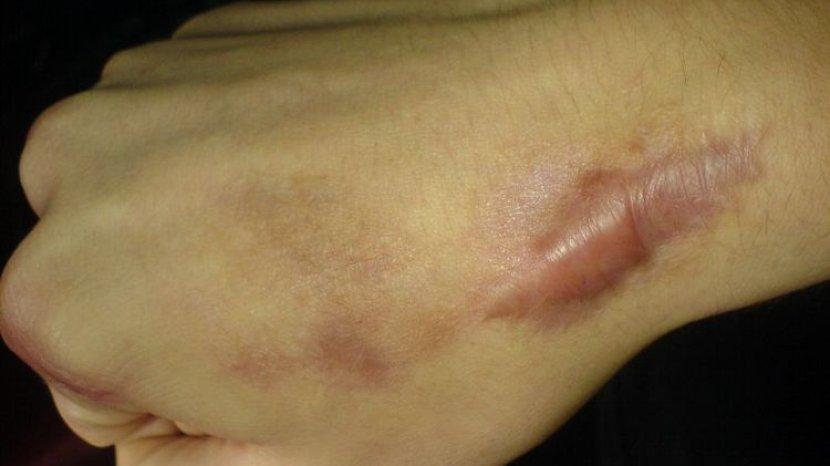 Hempas Keloid dengan Aman Menggunakan 9 Bahan Alami Ini, Murah dan Ampuh