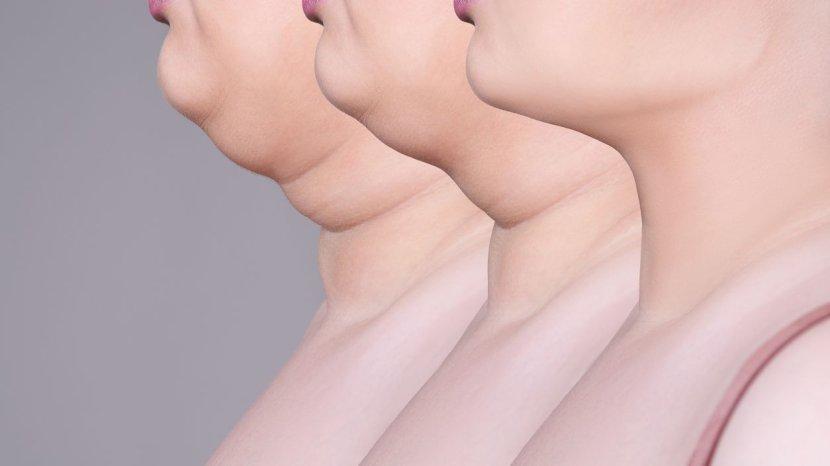 7 Cara Menghilangkan Double Chin Tanpa Treatment dan Operasi, Mudah dan Murah