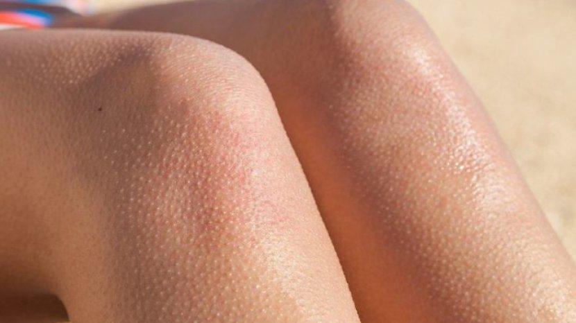 7 Cara Mengurangi Gejala Penyakit Kulit Ayam atau Chicken Skin Agar Tidak Terlalu Parah