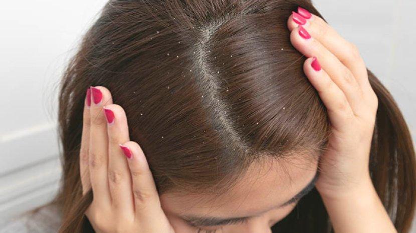 5 Rekomendasi Shampo Penghilang Ketombe Terbaik, Rambut Super Bersih Bebas Gatal