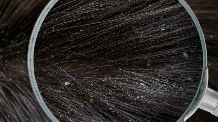 Kulit Kepala Gatal dan Mengelupas Bisa Jadi Tanda Mengalami Borok, Ini 6 Cara Mengatasinya