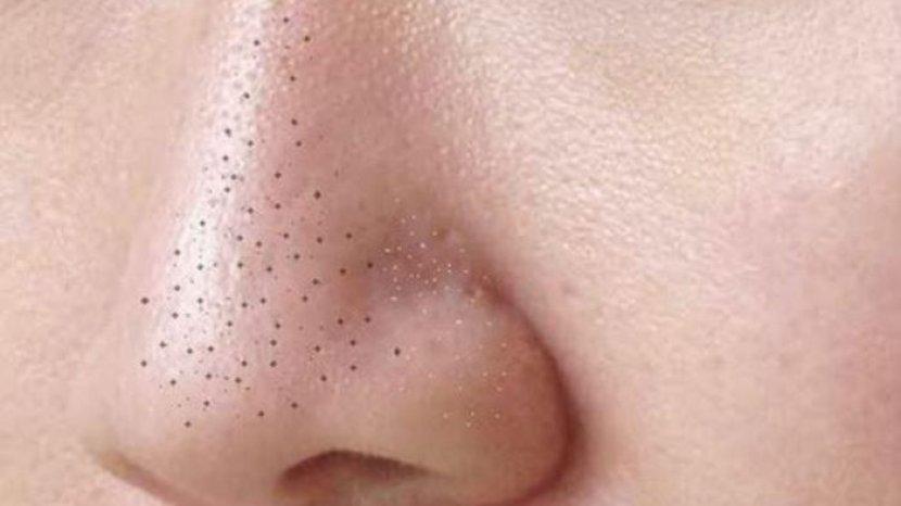 5 Bahan Alami untuk Hempas Komedo tanpa Biaya Mahal