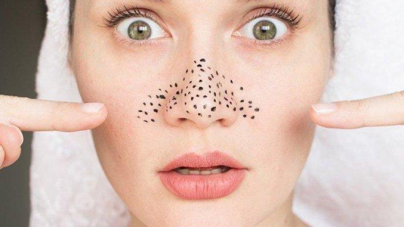 5 Tips Ampuh Atasi Komedo Hitam atau Blackhead yang Membandel di Wajah