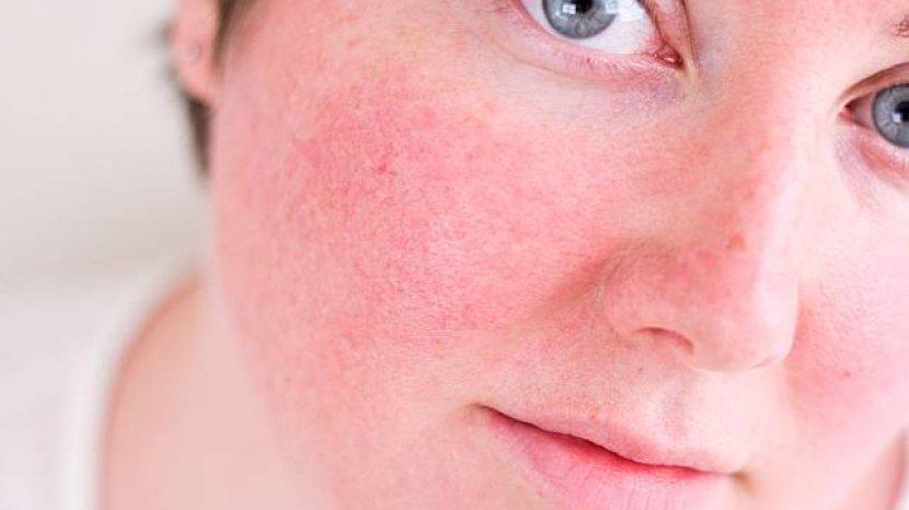 5 Tips Mengatasi Pipi Memerah karena Terbakar Paparan Sinar UV Matahari yang Berlebih