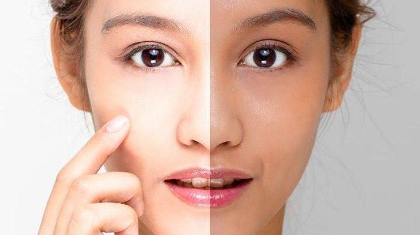 5 Cara Alami Mengatasi Kulit Belang tanpa Biaya Mahal, Bisa Dilakukan di Rumah