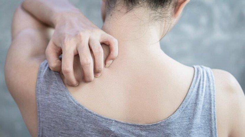Kulit Gatal-gatal Karena Panu? Atasi dengan 4 Bahan Alami Ini