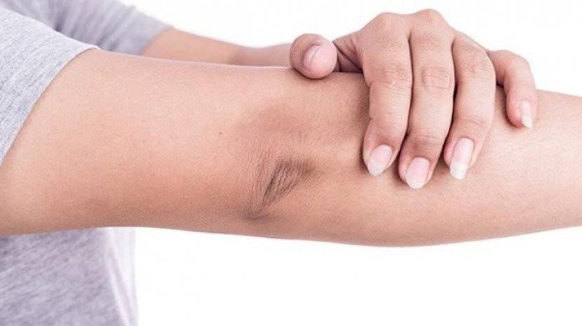 6 Cara Efektif untuk Mengatasi Kulit Siku yang Kering