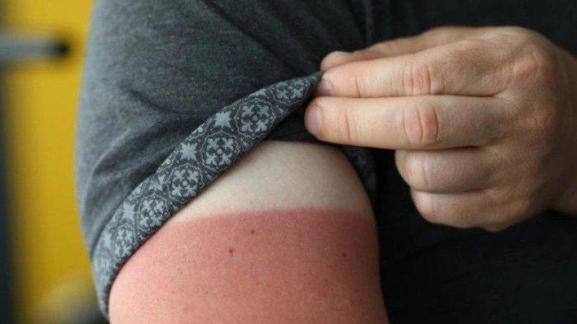 7 Cara Mudah dan Ampuh Mengatasi Belang di Tangan, Cukup Pakai Bahan Rumahan