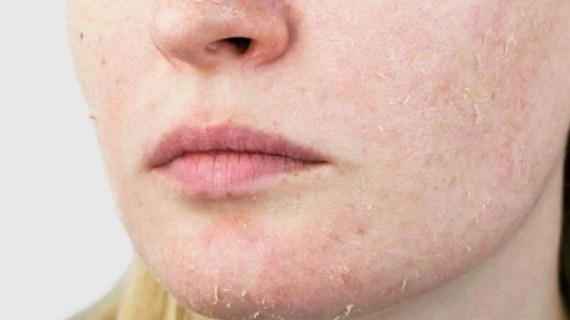9 Kandungan Skincare Cocok untuk Kulit Kering agar Kembali Lembap