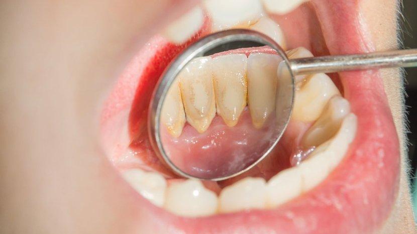 7 Cara yang Bisa Merontokkan Karang Gigi Secara Alami, Benarkah Manjur?