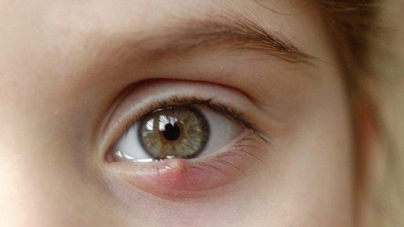 5 Rekomendasi Obat Mata Bintitan, Ada yang Bebas Dibeli Tanpa Resep Dokter