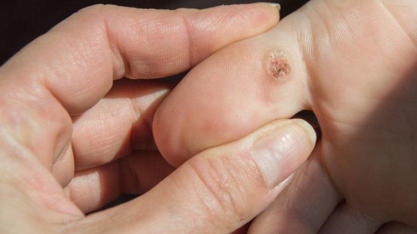 10 Bahan Alami Ampuh Mengatasi Mata Ikan di Telapak Kaki, Mudah dan Murah