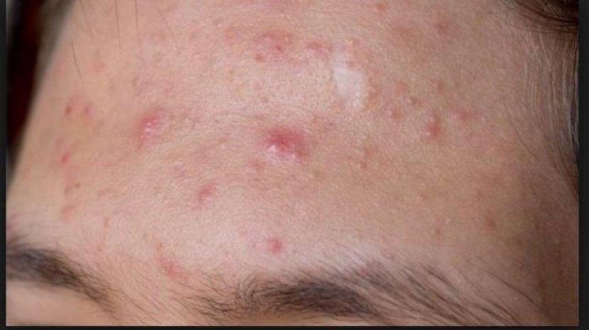 Jerawat Meradang Jangan Dipencet, Atasi dengan 6 Obat Jerawat Ini