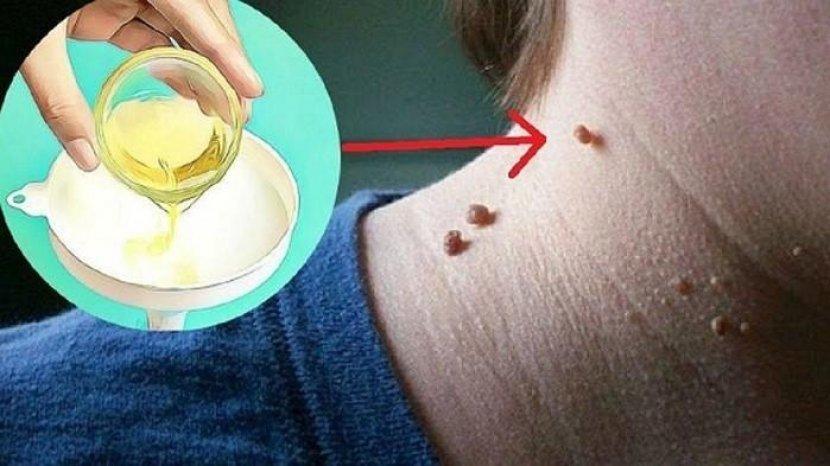 Terganggu dengan Kutil yang Ada di Tubuhmu? Ini 5 Cara Alami untuk Menghilangkannya