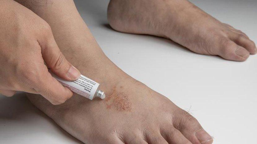 7 Rekomendasi Salep Jamur yang Bisa Dibeli di Apotek Terdekat, Basmi Sampai ke Akar