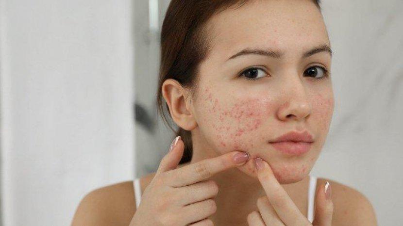 Rekomendasi 3 Produk Skincare untuk Kulit Sensitif Tersedia di Sociolla