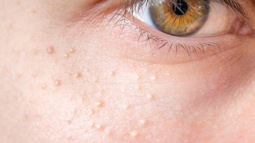5 Cara Mudah Mengatasi Milia di Wajah, Benjolan Kecil Mirip Jerawat yang Mengganggu Penampilan