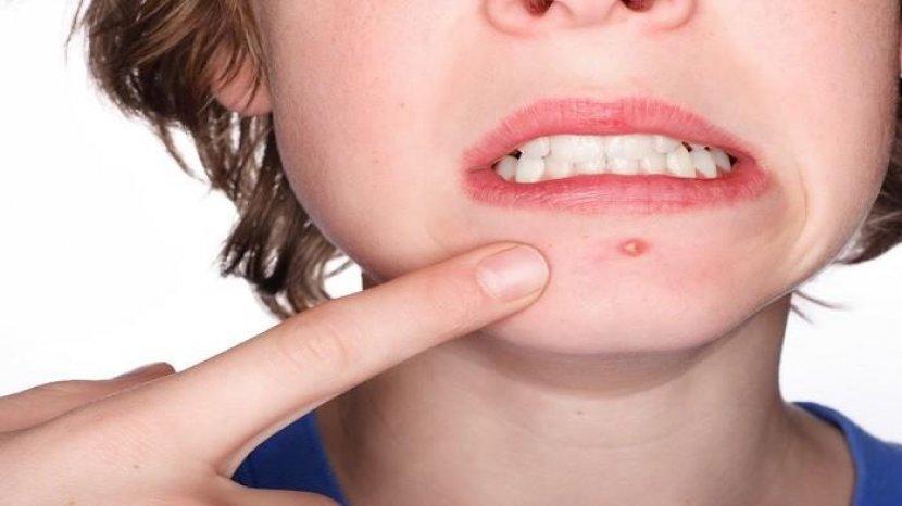 5 Kebiasaan Sepele yang Justru Memperparah Kulit Berjerawat