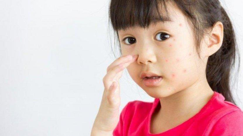 Cara Ini Dapat Membantu Orang Tua Mendeteksi Lebih Dini Adanya Alergi pada Si Kecil