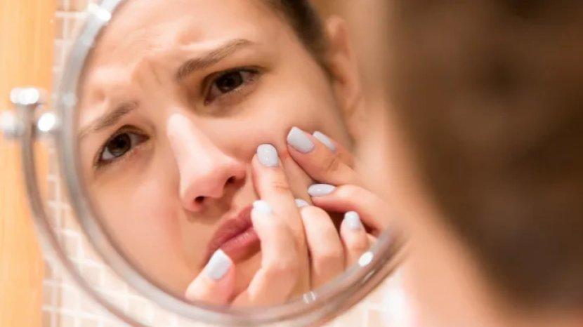 Pakai 9 Bahan Alami Ini untuk Menghilangkan Bekas Jerawat, Warna Kulit Kembali Merata