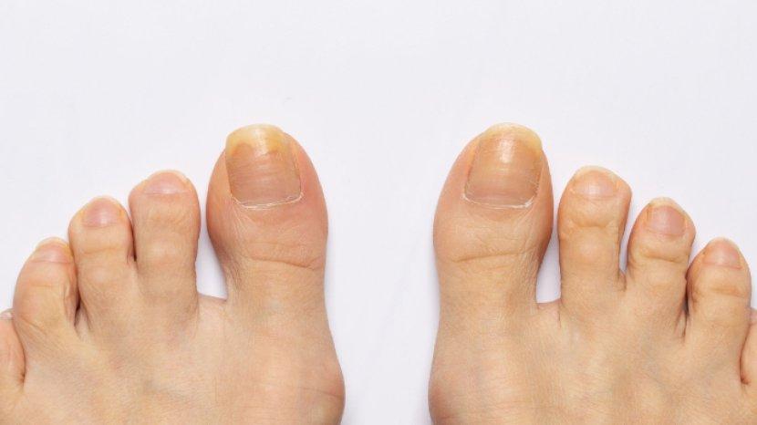 Ketahui Penyebab dan Cara Mengatasi Kuku Kuning, Salah Satunya Pakai Baking Soda