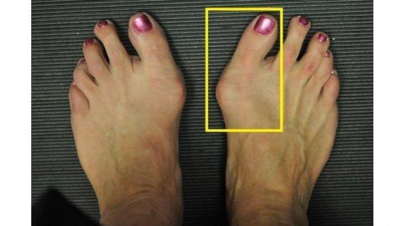 Ketahui Penyebab Pergeseran Tulang Ibu Jari Kaki atau Bunion yang Sering Dialami Para Wanita