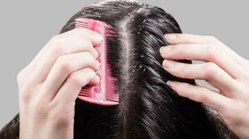 Tanpa Efek Samping, Atasi Ketombe dengan 5 Bahan Alami Ini