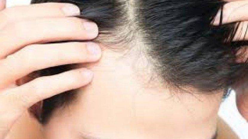 Takut Mengalami Kebotakan? Berikut 9 Rekomendasi Suplemen Penumbuh Rambut Terbaik