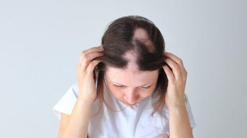 Rambut Sangat Rontok hingga Menimbulkan Kebotakan? Atasi dengan 7 Bahan Alami Ini