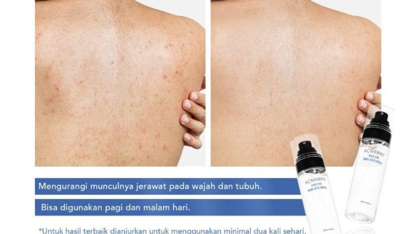 salah-satu-rekomendasi-acne-spray-yang-ampuh-mengatasi-jerawat-punggung.jpg
