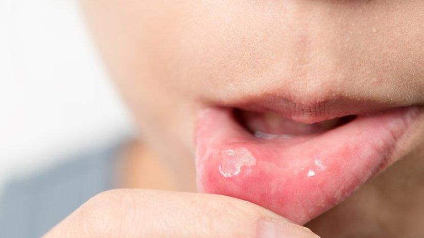 8 Obat Sariawan Alami ini Bisa Kamu Coba di Rumah, Apa Saja?