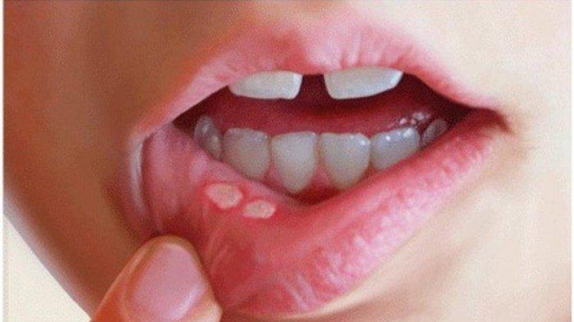 Jaga Bibir Tetap Sehat, Ini 5 Cara Mudah Mencegah Sariawan
