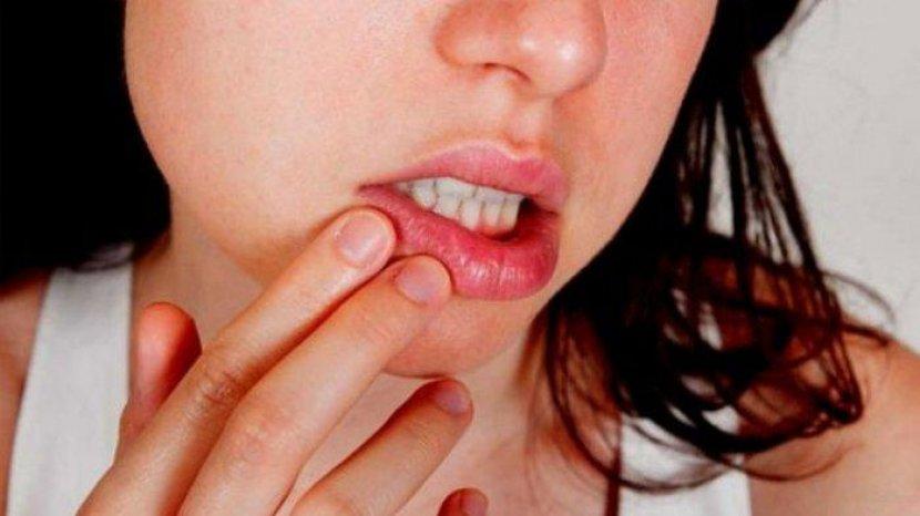 7 Obat Sariawan Alami, Hempas Rasa Perih dan Nyeri yag Bikin Nafsu Makanmu Hilang