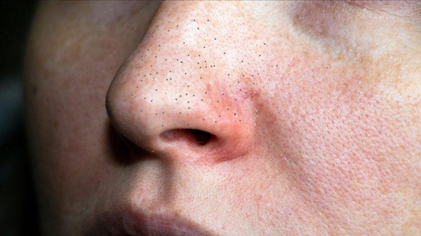 sebaceous-filaments.jpg