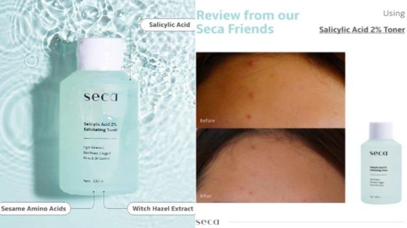 Review seca Acne & Oil Control Salicylic Acid 2 Persen Exfoliating Toner Aman untuk Kulit Berjerawat