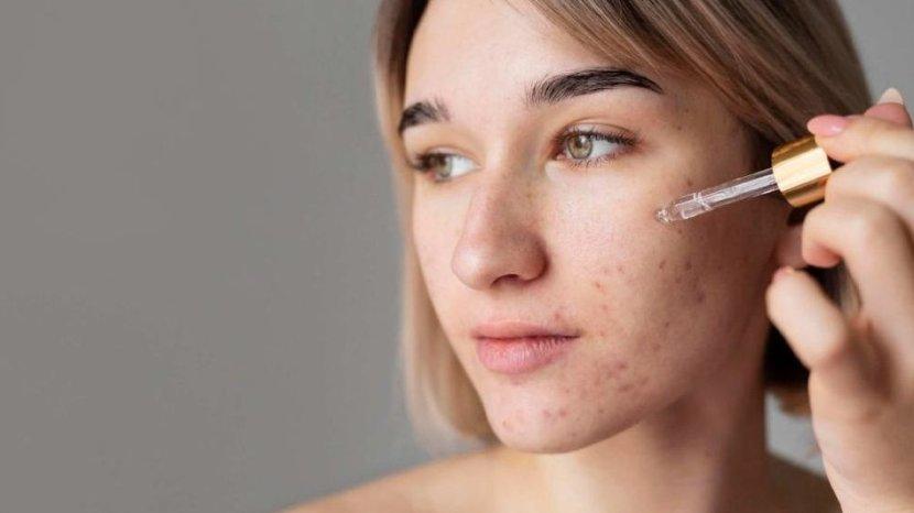 Jangan Asal, Ini 7 Tips Penting Memilih Serum untuk Kulit Jerawatan