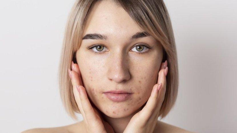 Hilangkan Bekas Jerawat dengan 5 Serum Wajah Terbaik
