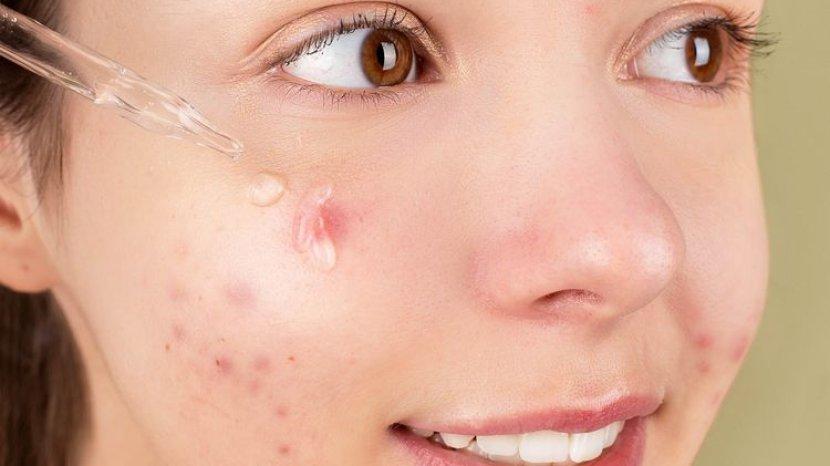 7 Kandungan Skincare yang Ampuh Mengatasi Jerawat