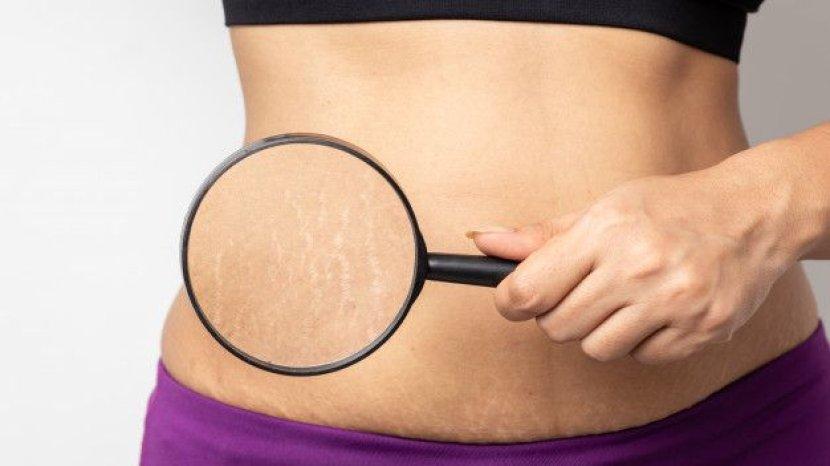 5 Rekomendasi Penghilang Stretch Mark Terbaik Paling Laris di Shopee, Yuk Coba