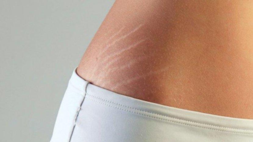 Tersedia di Sociolla, 4 Produk untuk Atasi Masalah Stretch Mark dan Selulit