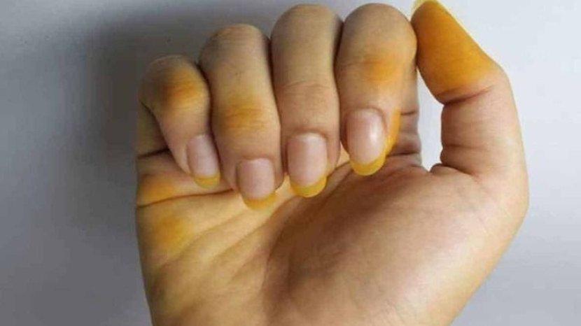 Tangan dan Kuku Jadi Kuning Gara-gara Kunyit? Tenang, 7 Cara Mudah ini Ampuh Membersihkannya