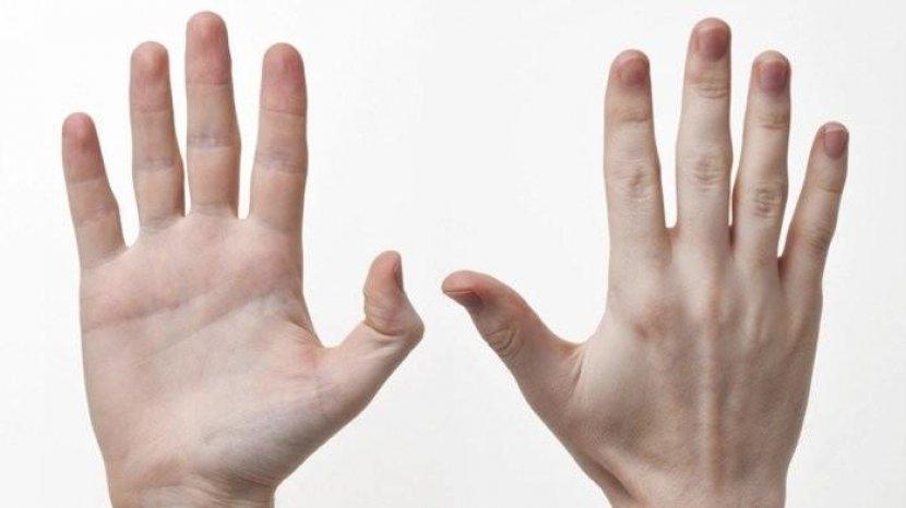 7 Cara Alami Mengatasi Kapalan di Telapak Tangan