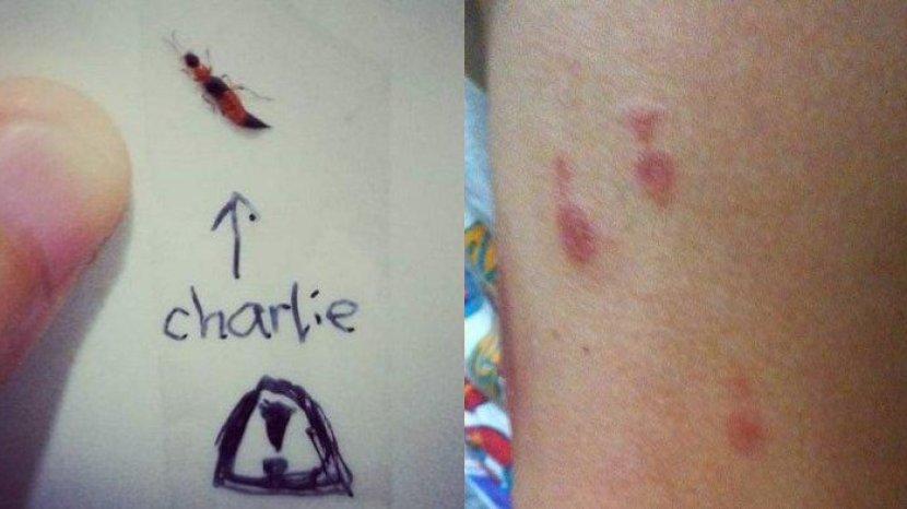 Waspada Radang Kulit Akibat Racun Tomcat Mudah Menyebar, ini Cara Mengobatinya