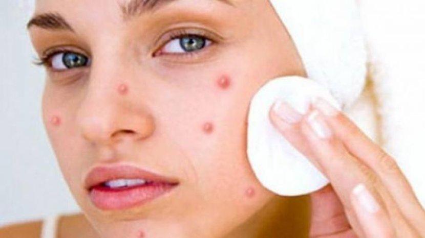 5 Rekomendasi Toner Jerawat Terbaik, Ada SKINTIFIC hingga whitelab 